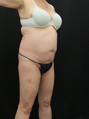 Liposuction: Case 20 - Before