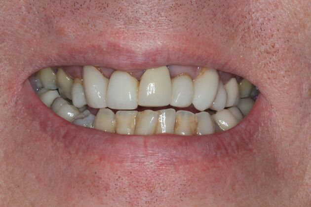 Dental Implants Case 12 - Before