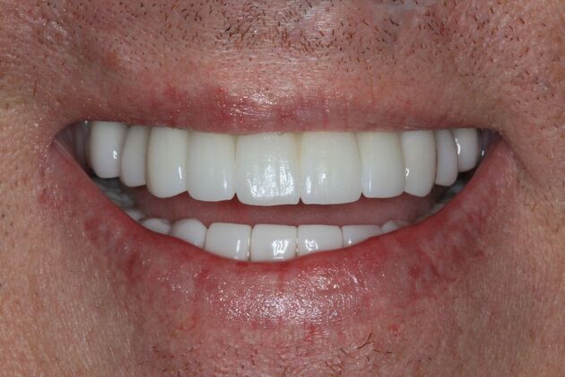 Dental Implants Case 12 - After