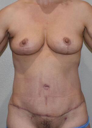 Mommy Makeover Case 289 - After