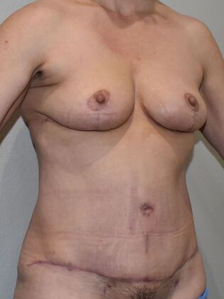 Mommy Makeover: Case 289 - After