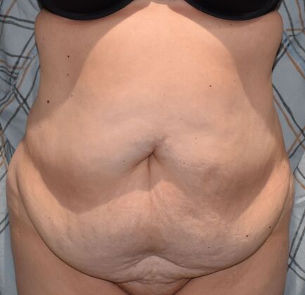 Tummy Tuck (Abdominoplasty): Case 448 - Before