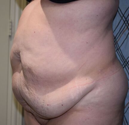 Tummy Tuck (Abdominoplasty): Case 448 - Before