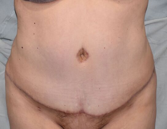 Tummy Tuck (Abdominoplasty): Case 448 - After