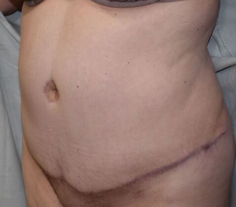 Tummy Tuck (Abdominoplasty): Case 448 - After