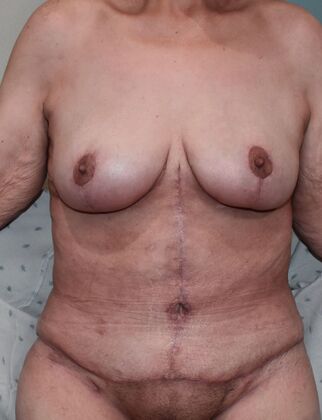 Massive Weight Loss : Case 140 - After