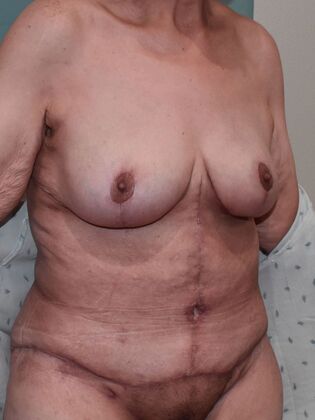 Mommy Makeover: Case 290 - After