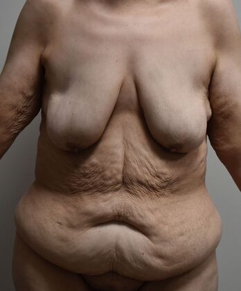 Mommy Makeover Case 290 - Before