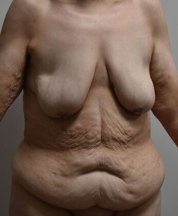 Mommy Makeover: Case 290 - Before