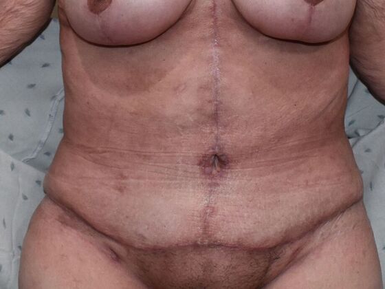 Tummy Tuck (Abdominoplasty): Case 449 - After