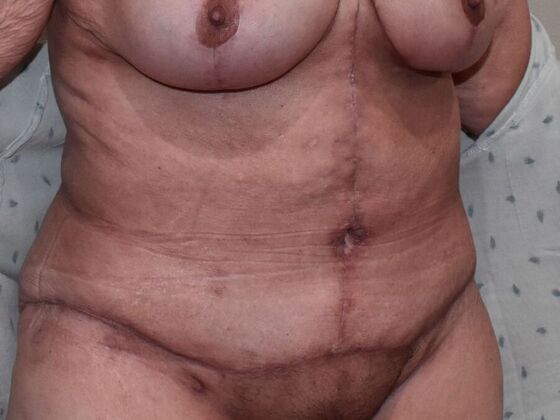 Tummy Tuck (Abdominoplasty): Case 449 - After