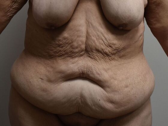 Tummy Tuck (Abdominoplasty): Case 449 - Before