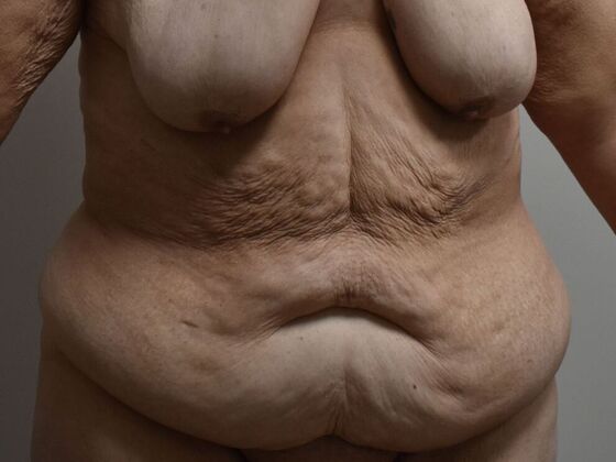 Tummy Tuck (Abdominoplasty): Case 449 - Before