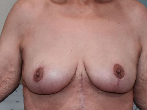 Breast Lift (Mastopexy) Case 187 - After