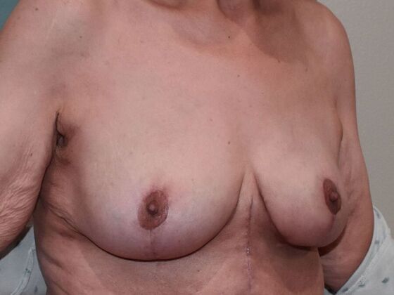 Breast Lift (Mastopexy): Case 187 - After