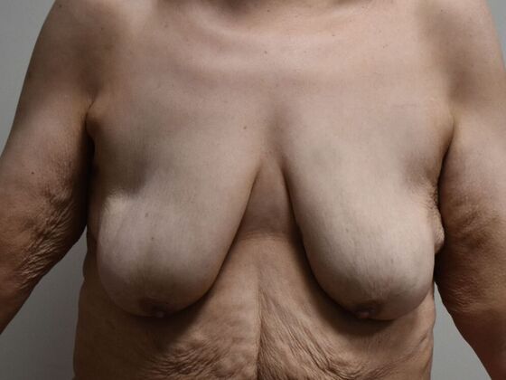 Breast Lift (Mastopexy) Case 187 - Before