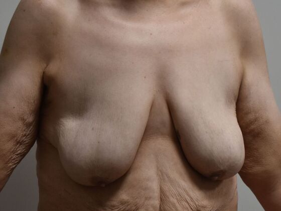 Breast Lift (Mastopexy): Case 187 - Before