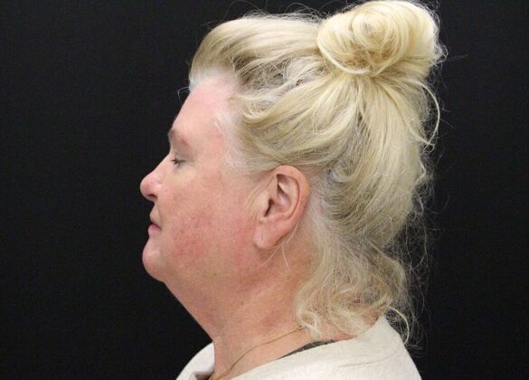Face & Neck Lifts: Case 27 - Before