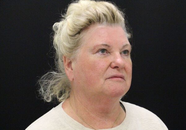 Face & Neck Lifts: Case 27 - Before