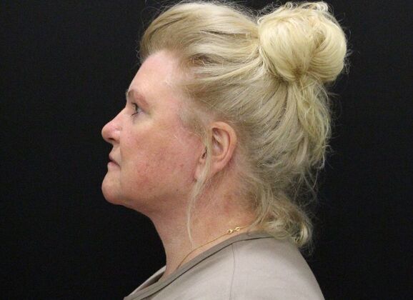 Face & Neck Lifts: Case 27 - After