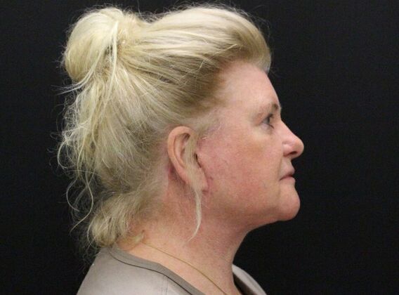 Face & Neck Lifts: Case 27 - After