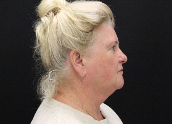 Face & Neck Lifts: Case 27 - Before