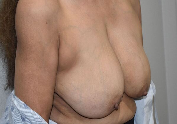 Breast Lift (Mastopexy): Case 188 - Before