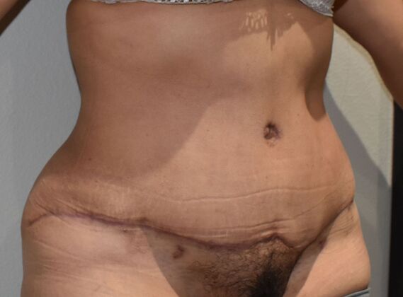 Tummy Tuck (Abdominoplasty): Case 450 - After