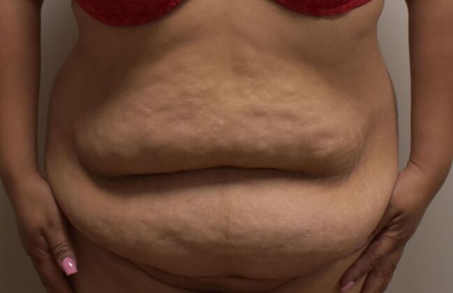 Tummy Tuck (Abdominoplasty): Case 451 - Before