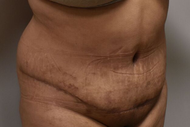 Tummy Tuck (Abdominoplasty): Case 451 - After