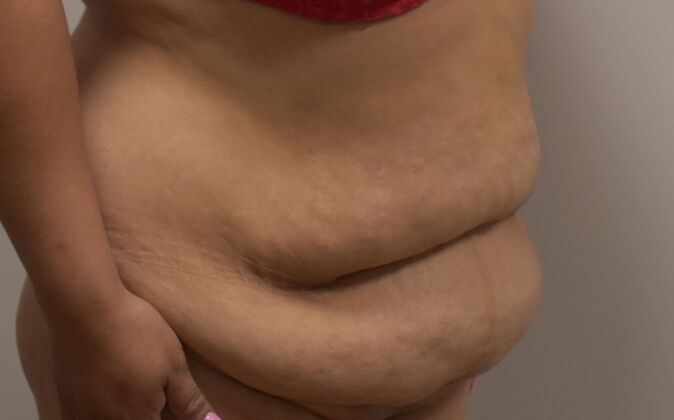 Massive Weight Loss : Case 141 - Before