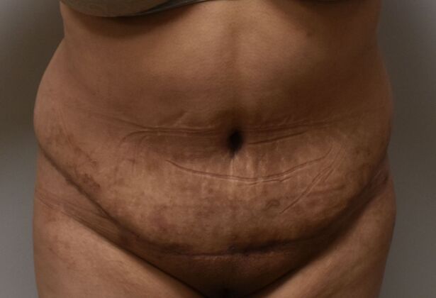 Massive Weight Loss : Case 141 - After