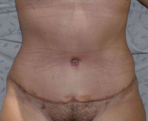 Tummy Tuck (Abdominoplasty): Case 452 - After