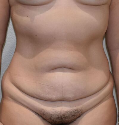 Tummy Tuck (Abdominoplasty): Case 452 - Before