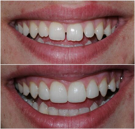 Smile Makeover Album Case 10 - Before