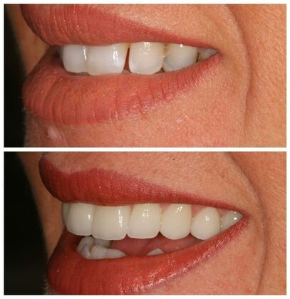 Smile Makeover Album Case 10 - After