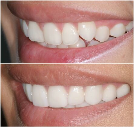 Smile Makeover Album: Case 10 - Before