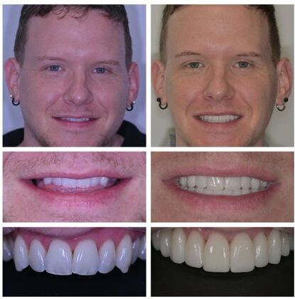 Smile Makeover Album: Case 10 - After
