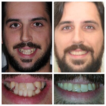 Orthodontics: Various Cases 3 - Before