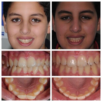 Orthodontics: Various Cases 3 - After