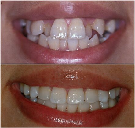 Orthodontics: Various Cases 3 - Before