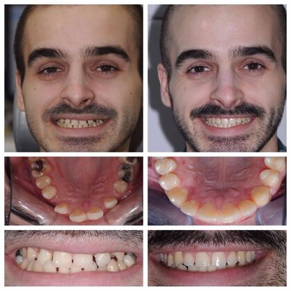 Orthodontics: Various Cases 3 - Before
