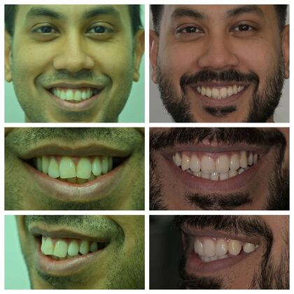 Orthodontics: Various Cases 3 - After