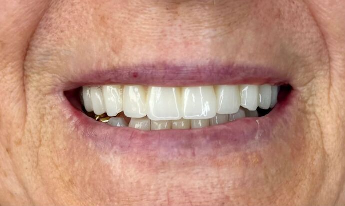Full Mouth Reconstruction Case 2 - After