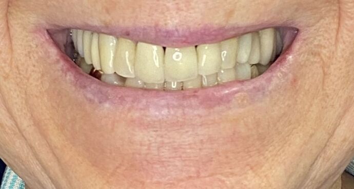 Full Mouth Reconstruction Case 2 - Before
