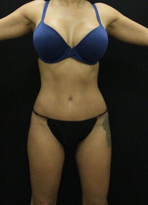 Tummy Tuck Case 57 - After