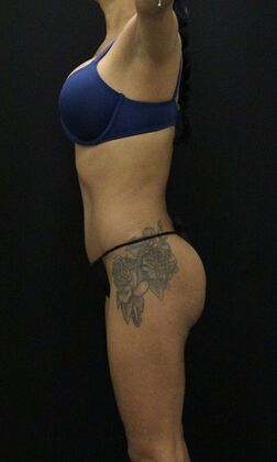 Tummy Tuck: Case 57 - After