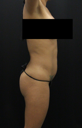 Tummy Tuck: Case 57 - Before
