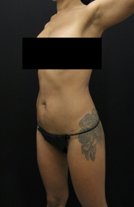 Tummy Tuck: Case 57 - Before