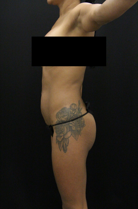 Tummy Tuck: Case 57 - Before